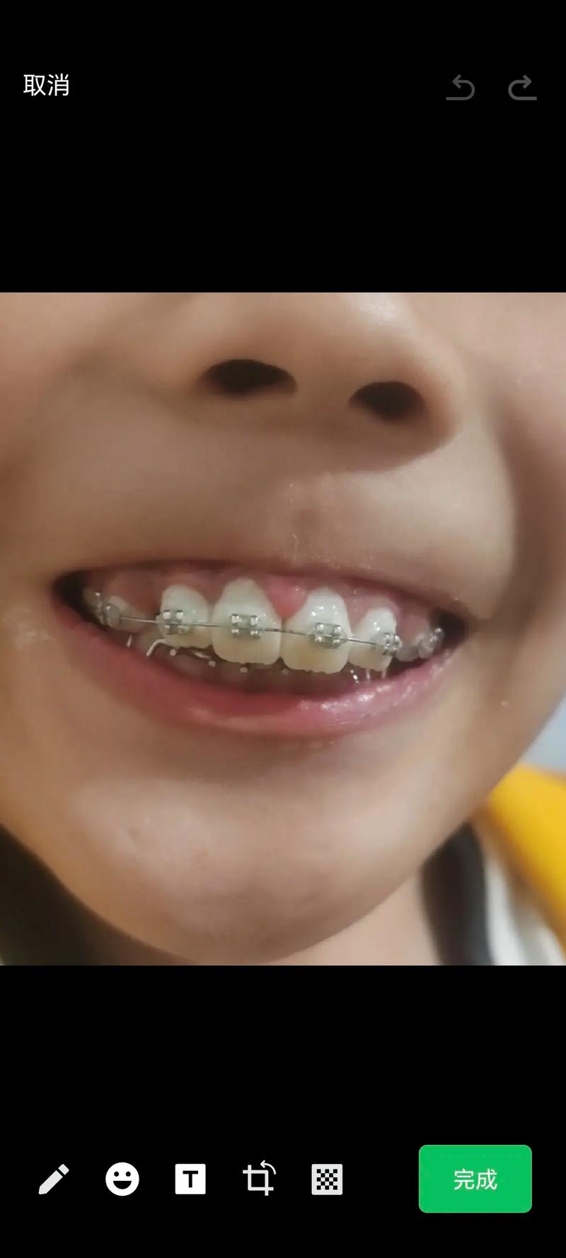 杭州口腔医院儿童正畸,孩子几岁开始矫正效果最佳?-图2 杭州口腔医院儿童正畸,孩子几岁开始矫正效果最佳?-图2