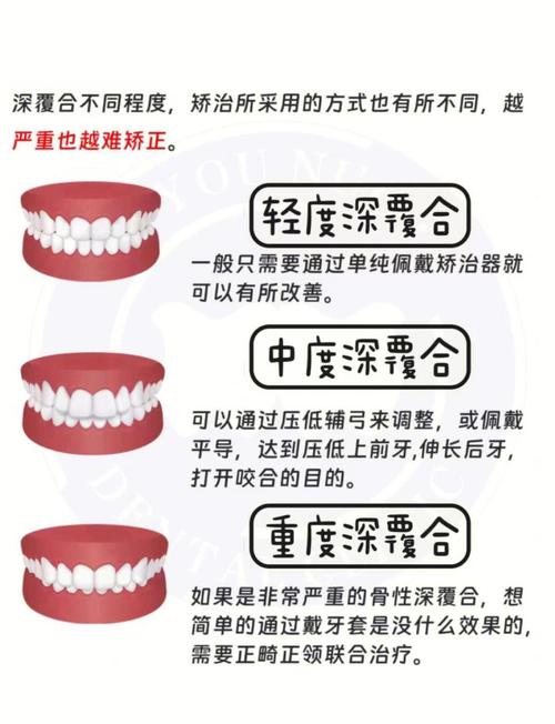 深覆合的修复治疗方法-图2