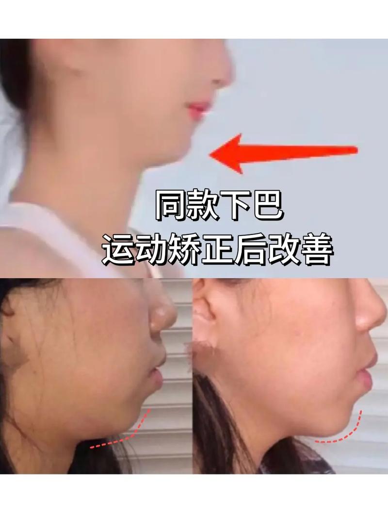 下巴后缩矫正日常方法-图2