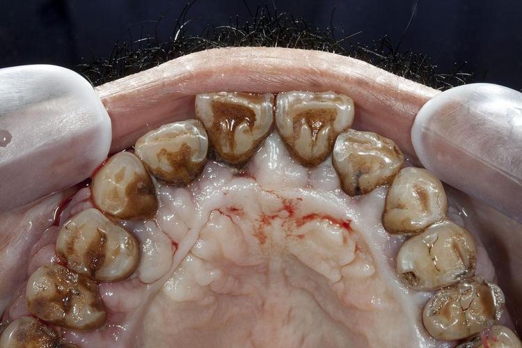 种牙前需要做牙周炎吗-图3