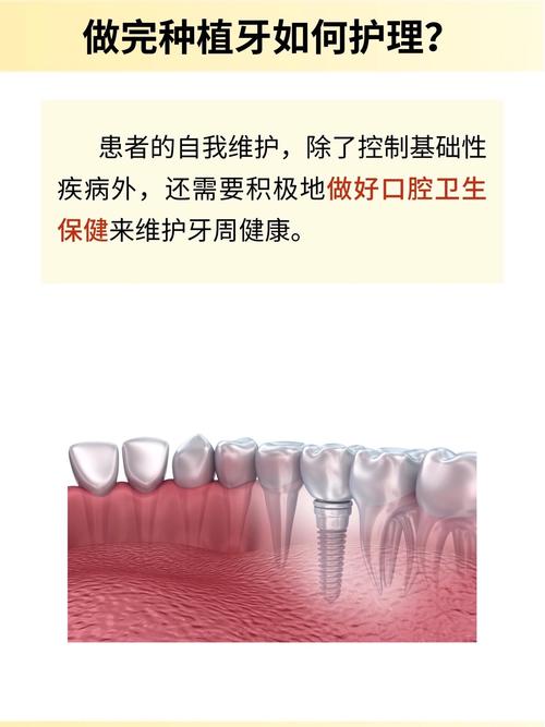 种植牙种完后，日常护理该怎么做？-图3
