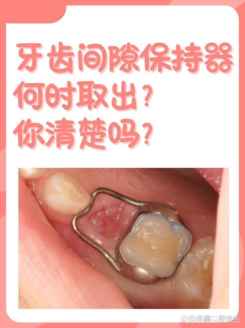 正畸关闭间隙后还要多久完成矫正?-图2 正畸关闭间隙后还要多久完成矫正?-图2