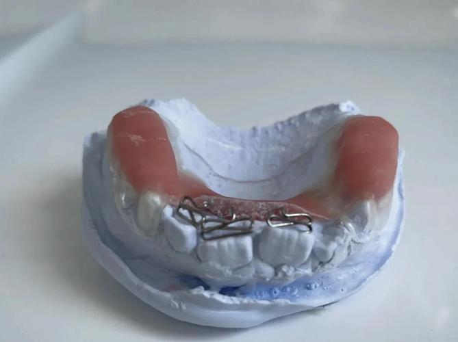 口腔正畸固定矫治是什么?它如何矫正牙齿?-图2 口腔正畸固定矫治是什么?它如何矫正牙齿?-图2