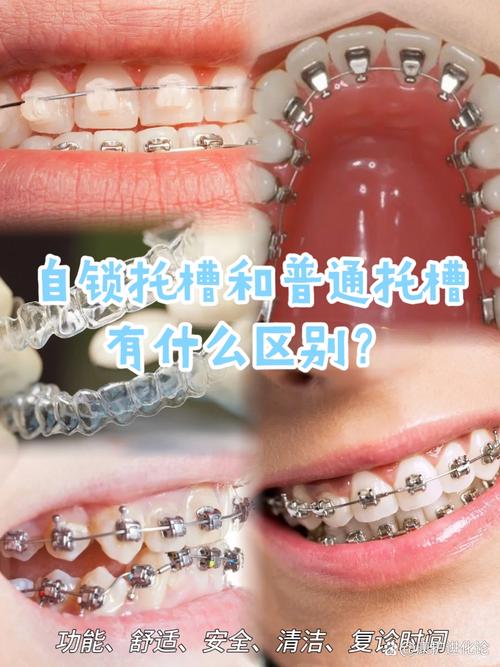 口腔正畸固定矫治是什么?它如何矫正牙齿?-图1 口腔正畸固定矫治是什么?它如何矫正牙齿?-图1