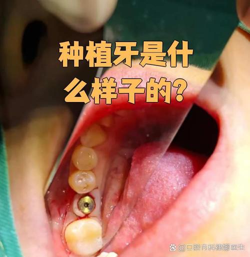 种牙像真的真牙一样吗-图1