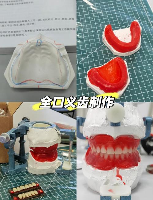 复杂活动义齿取模方法的关键步骤、操作技巧及注意事项有哪些?-图1 复杂活动义齿取模方法的关键步骤、操作技巧及注意事项有哪些?-图1