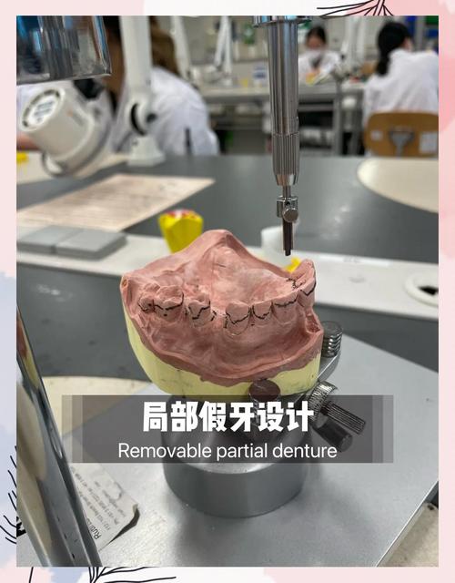 复杂活动义齿取模方法的关键步骤、操作技巧及注意事项有哪些?-图2 复杂活动义齿取模方法的关键步骤、操作技巧及注意事项有哪些?-图2