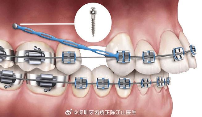 口腔正畸八字结扎方法-图3