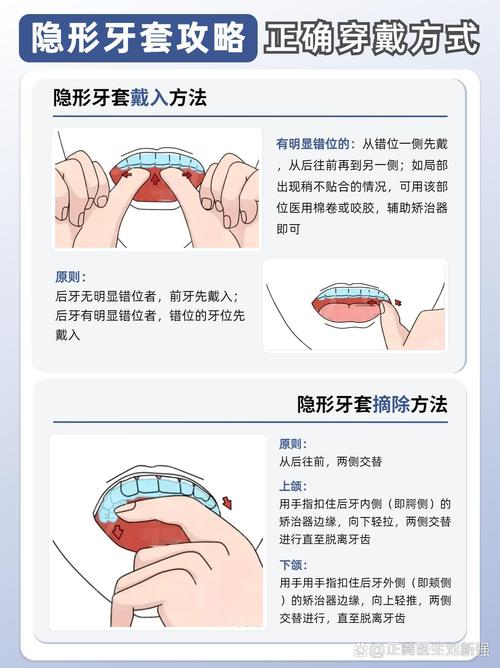 隐形矫治器怎么摘?正确方法与技巧是什么?-图1 隐形矫治器怎么摘?正确方法与技巧是什么?-图1