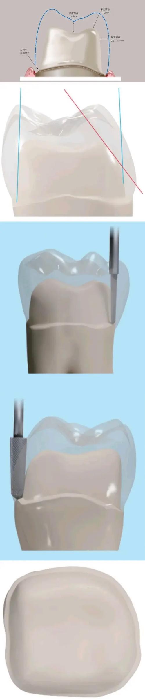 牙体预备邻面预备方法-图1