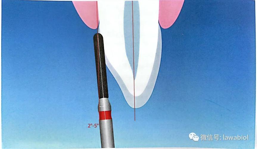 牙体预备邻面预备方法-图3