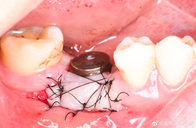 游离末端缺失修复方法的关键技术及优化方向是什么？-图1