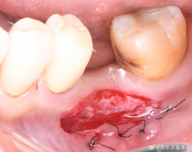 游离末端缺失修复方法的关键技术及优化方向是什么？-图2