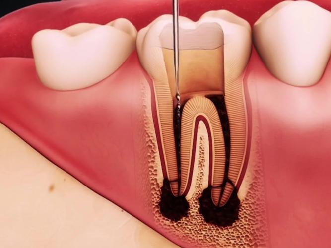 前牙根管治疗方法视频-图1