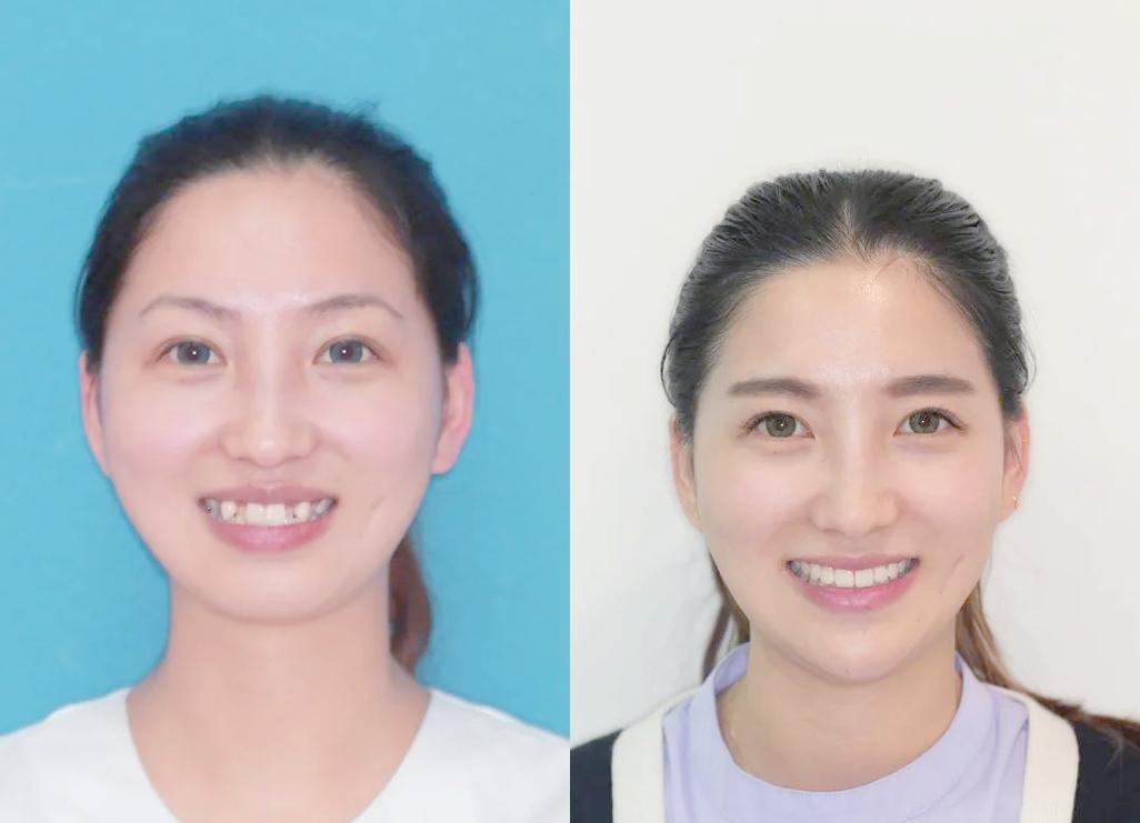 为什么正畸最难移动的就是虎牙？-图2