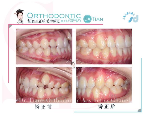 为什么正畸最难移动的就是虎牙？-图1