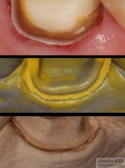 硅橡胶取桩核视频中,取桩核方法的具体操作步骤是怎样的?-图1 硅橡胶取桩核视频中,取桩核方法的具体操作步骤是怎样的?-图1