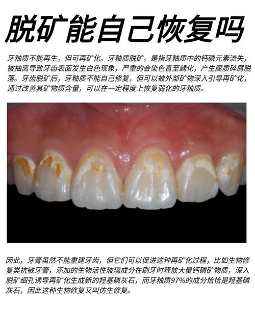 正畸期间牙齿脱矿图片能说明什么问题?-图2 正畸期间牙齿脱矿图片能说明什么问题?-图2