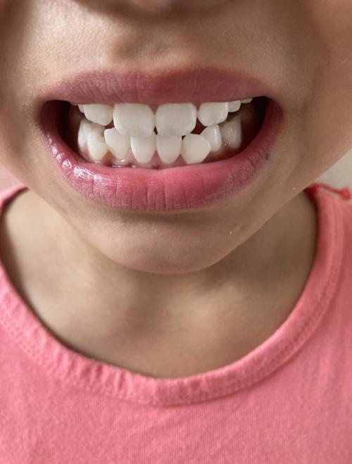 正畸期间牙齿脱矿图片能说明什么问题?-图1 正畸期间牙齿脱矿图片能说明什么问题?-图1