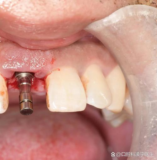 种牙骨高度不足，植骨为何必不可少？-图1