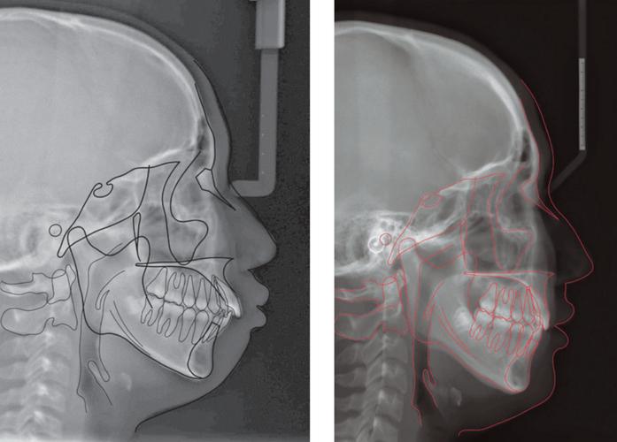 正畸头颅侧位片摆放如何规范?关键步骤有哪些?-图1 正畸头颅侧位片摆放如何规范?关键步骤有哪些?-图1
