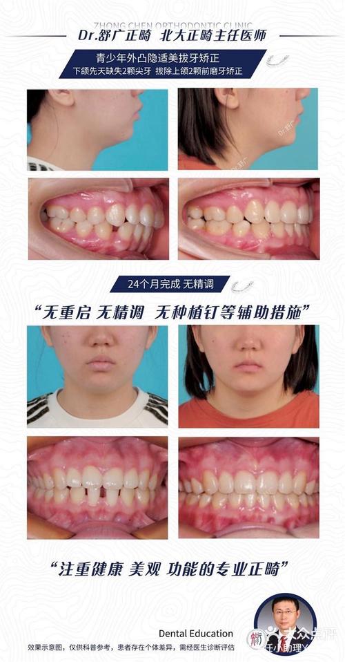 拔牙不种牙,智齿正畸可行吗?会有哪些影响?-图2 拔牙不种牙,智齿正畸可行吗?会有哪些影响?-图2