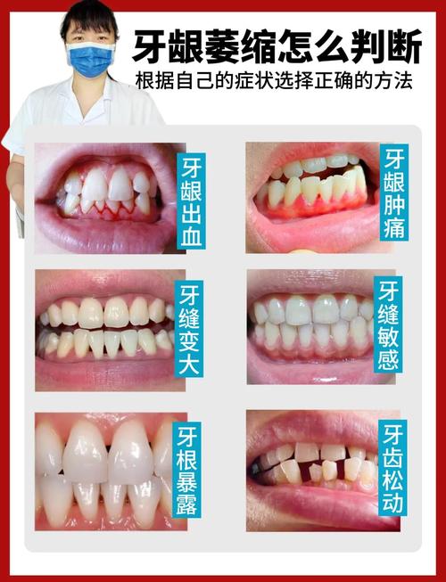牙龈萎缩有哪些手术治疗方法？-图1