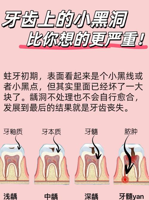 龋齿疼痛发作时，如何选择合适的治疗方法快速缓解疼痛？-图2