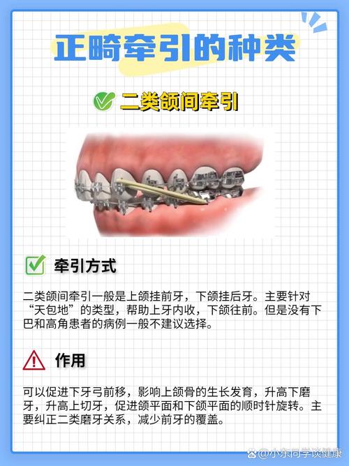 为什么要带口外正畸牵引-图2 为什么要带口外正畸牵引-图2