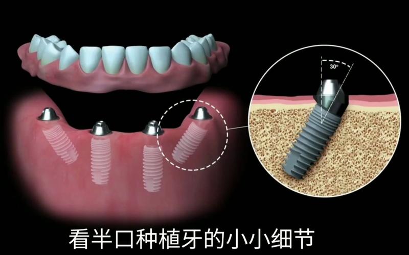 瑞士ITI基台种牙效果怎样?优势需注意哪些?-图3 瑞士ITI基台种牙效果怎样?优势需注意哪些?-图3