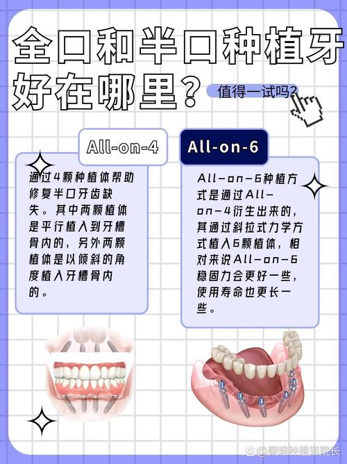 半口牙种植种多少个牙-图1 半口牙种植种多少个牙-图1