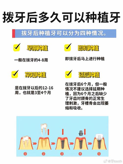 种牙即拔即种需要多久-图1 种牙即拔即种需要多久-图1