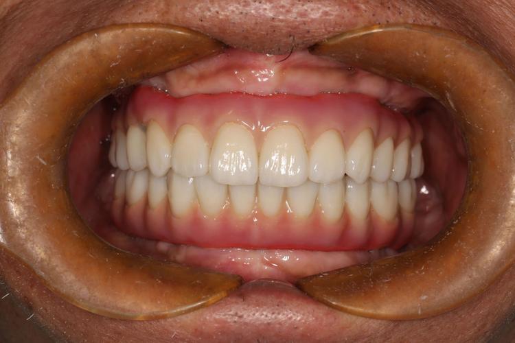 种牙后可以做牙周治疗-图2 种牙后可以做牙周治疗-图2