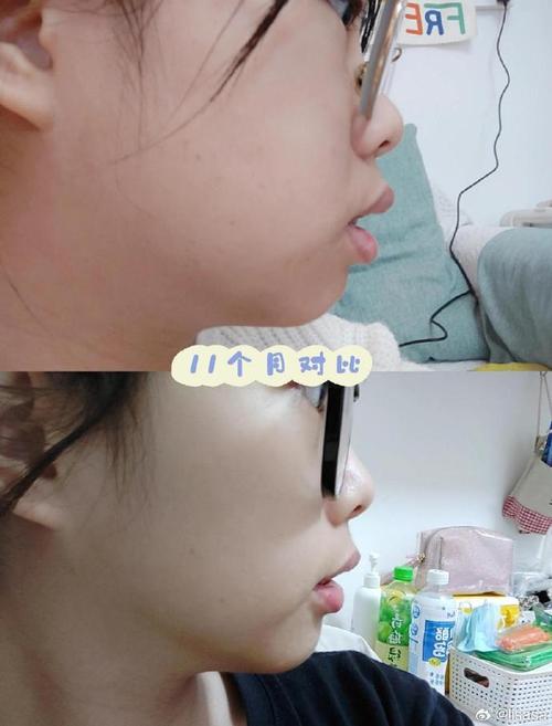 龅牙正畸半年效果对比图,牙齿变化真的有这么明显吗?-图2 龅牙正畸半年效果对比图,牙齿变化真的有这么明显吗?-图2