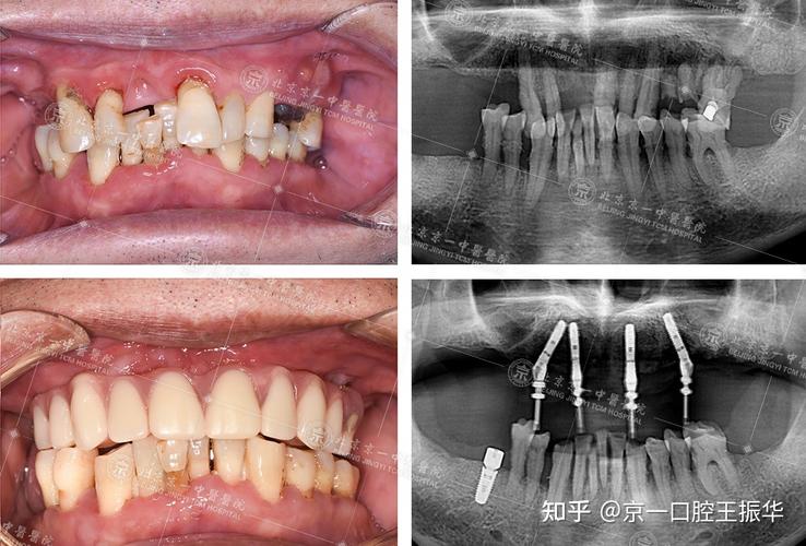北京种牙哪种比较好?种植体品牌、材料如何选?-图1 北京种牙哪种比较好?种植体品牌、材料如何选?-图1