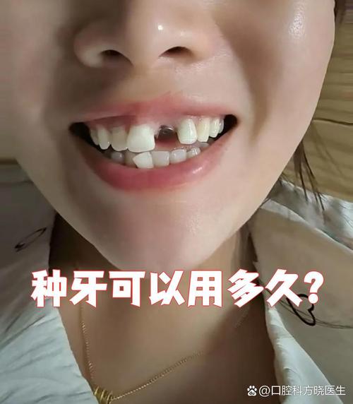 牙槽骨很硬就一定适合种牙吗?-图2 牙槽骨很硬就一定适合种牙吗?-图2