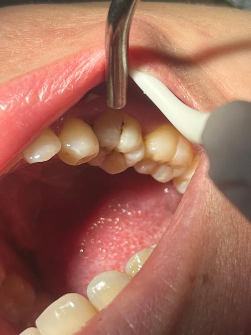 缺牙修复种牙为何打水漂?钱白花问题出在哪?-图1 缺牙修复种牙为何打水漂?钱白花问题出在哪?-图1