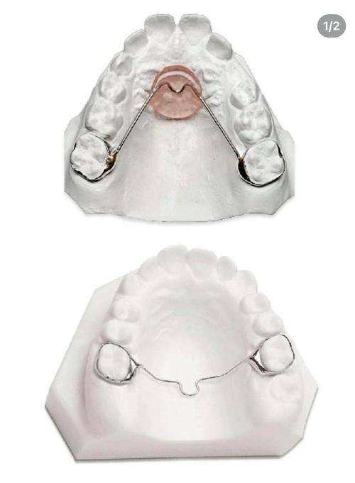 正畸nance弓的适应症具体包括哪些?-图1 正畸nance弓的适应症具体包括哪些?-图1