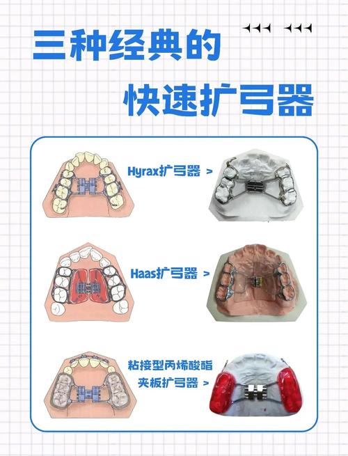 正畸nance弓的适应症具体包括哪些？-图3
