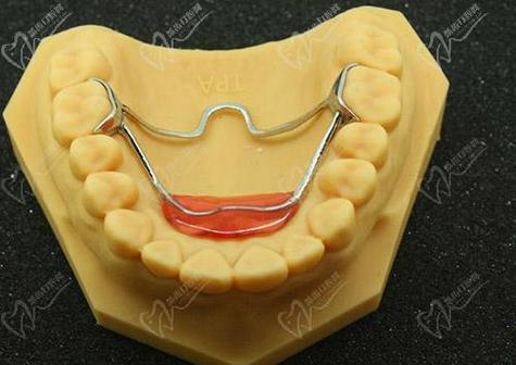 正畸nance弓的适应症具体包括哪些？-图2