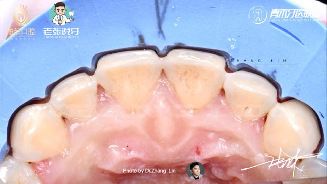 贴面切端预备方法图片-图3 贴面切端预备方法图片-图3