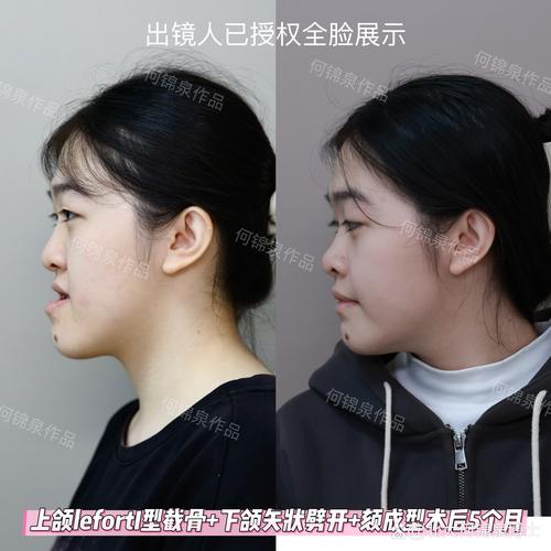 合肥华美整形牙齿正畸怎么样？效果、价格和服务如何？-图2