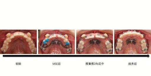 如何用图片测量正畸拥挤度?-图2 如何用图片测量正畸拥挤度?-图2