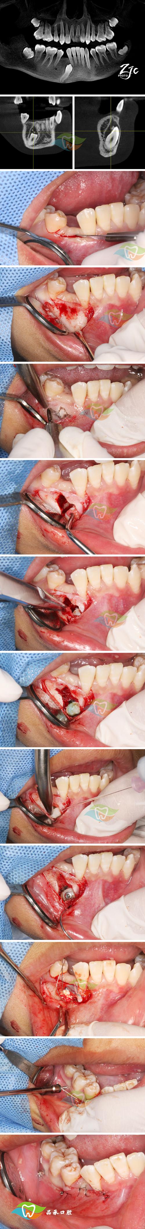 正畸治疗过程中牙周组织损害的常见类型有哪些?如何科学预防与处理?-图1 正畸治疗过程中牙周组织损害的常见类型有哪些?如何科学预防与处理?-图1