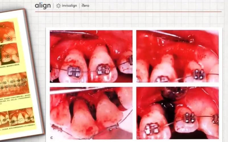 正畸治疗过程中牙周组织损害的常见类型有哪些？如何科学预防与处理？-图2
