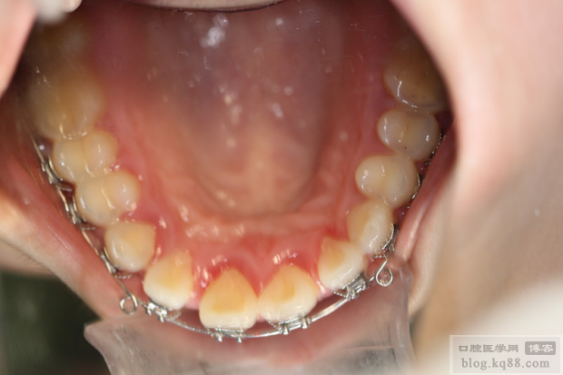 正畸治疗过程中牙周组织损害的常见类型有哪些?如何科学预防与处理?-图3 正畸治疗过程中牙周组织损害的常见类型有哪些?如何科学预防与处理?-图3