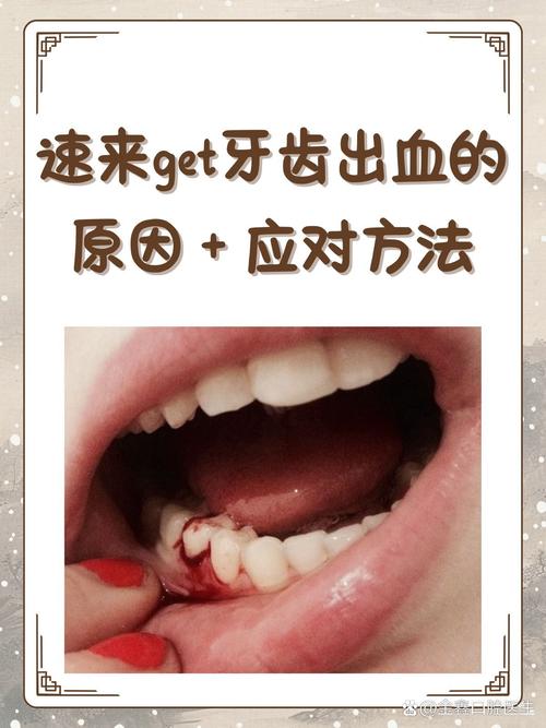 牙出血常见原因有哪些?如何科学治疗及预防牙龈出血?-图1 牙出血常见原因有哪些?如何科学治疗及预防牙龈出血?-图1