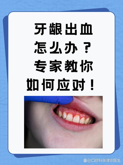 牙出血常见原因有哪些？如何科学治疗及预防牙龈出血？-图3