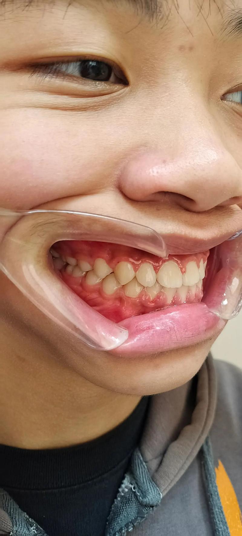 地包天 先手术 后正畸-图1