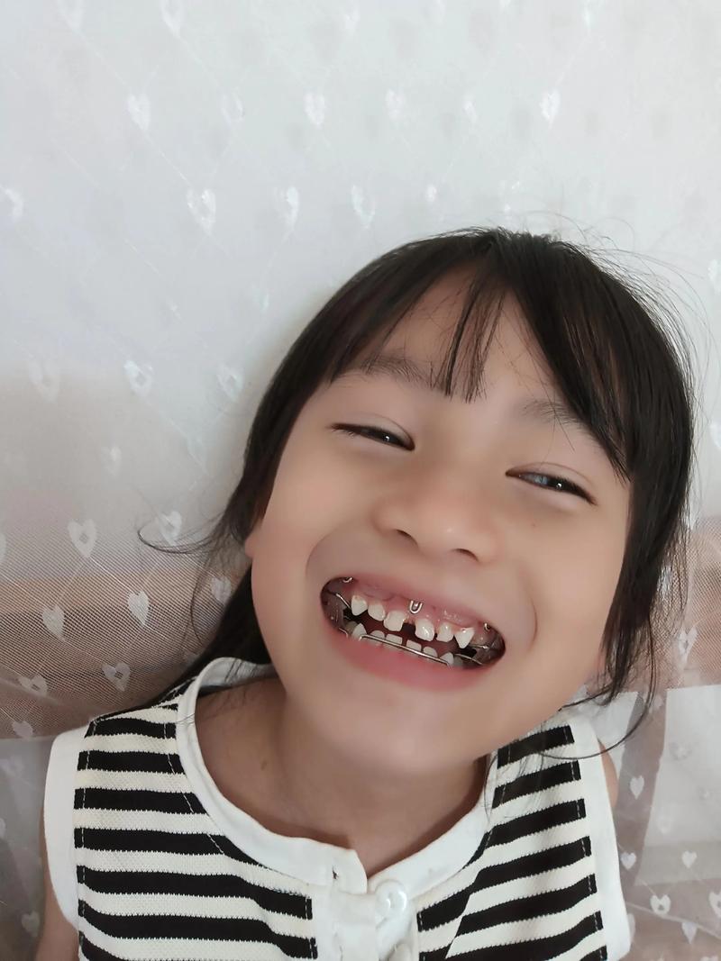 地包天 先手术 后正畸-图2